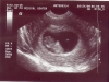 ultrasound3