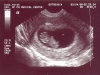 ultrasound30001